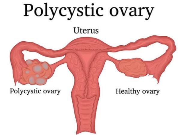 PCOS Diet Plan